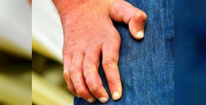 Avrupa'yı sarsan cüzzam alarmı: Romanya'da 44 yıl sonra ortaya çıktı, panik yayılıyor