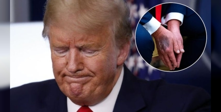 Donald Trump, elindeki morluğun sebebini aspirin kullanımına bağlıyor